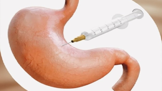 بوتاکس معده؛ راه حل سریع برای کاهش اشتها