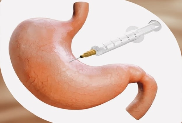 بوتاکس معده؛ راه حل سریع برای کاهش اشتها