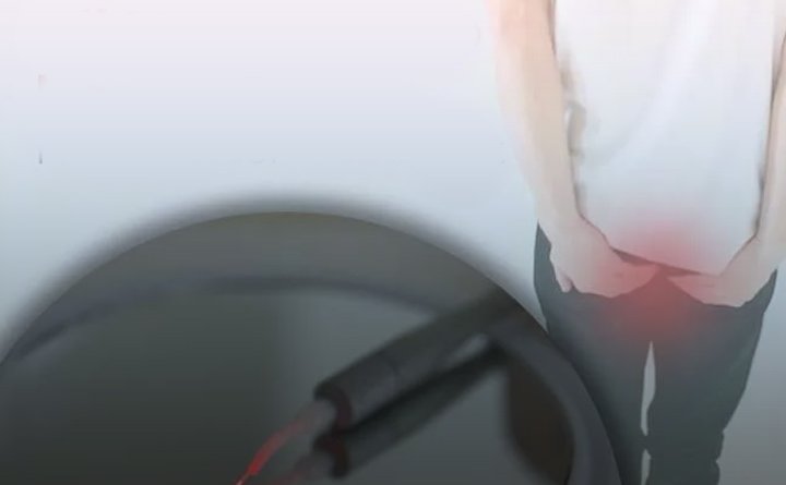 آیا ترشحات زرد رنگ بعد از عمل فیستول خطرناک است؟