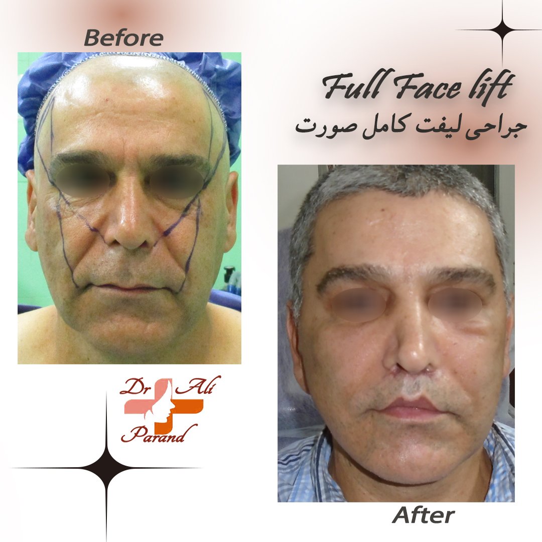 جراحی زیبایی صورت و عمل بوکال فت و تغییر در چهره